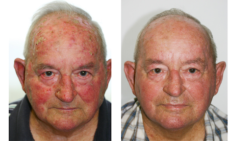PDT fast effective results at Skin Alert Paradise Point